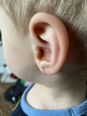 Leaking ear with visible pus.... it stinks bad