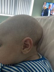 Anyone have experience with Sagittal craniosynostosis?