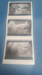 12 week scan