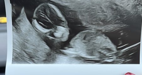 Nub theory boy or girl? 14+6