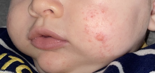 Rash/spots on baby cheeks???