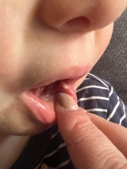 White lump in toddlers mouth
