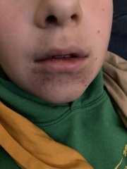 Can anyone identify this rash?