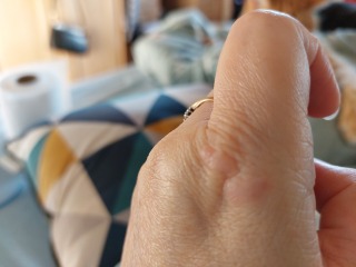 Strange red marks on hand