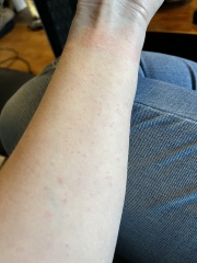 Please help, allergic reaction/scarlet fever or something else. 