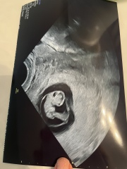 Pregnant after ivf - 5 weeks 