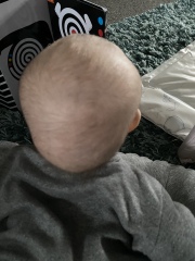 Does this look like Crainosynotosis?? Help!