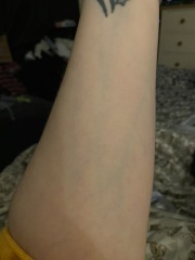 Very visible veins - Photo attached