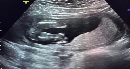 More worries - size & sex of baby 
