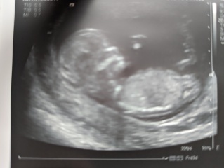 12 week scan. 3rd boy or 1st girl? 
