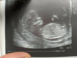 12 week scan. 3rd boy or 1st girl? 