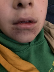 Can anyone identify this rash?