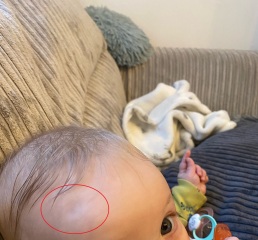 Indent on Babies Forehead