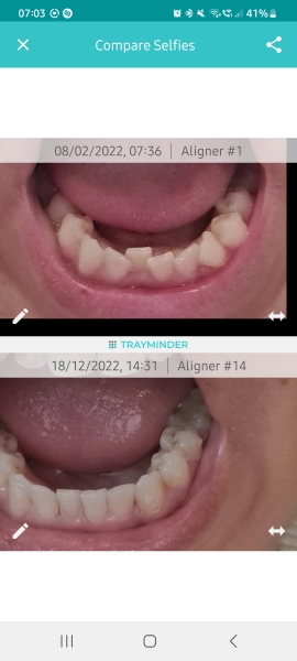AIBU to stop invisalign on Day 2?