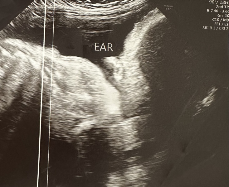 Weird ear on ultrasound?