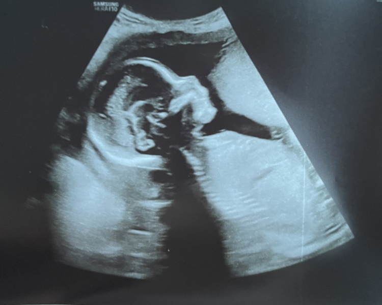 Very early pregnancy and so much anxiety after miscarriage