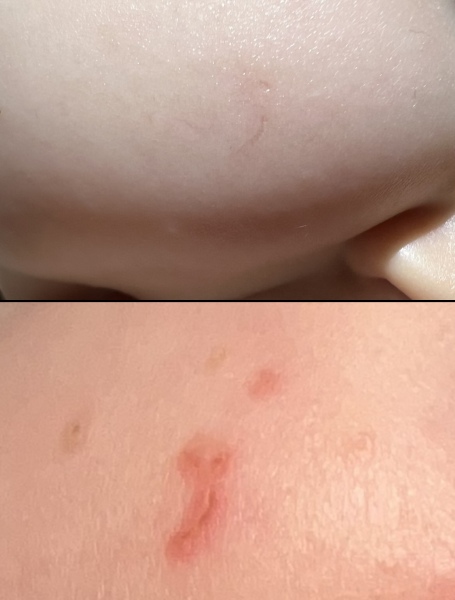 Baby scratched & scarred face