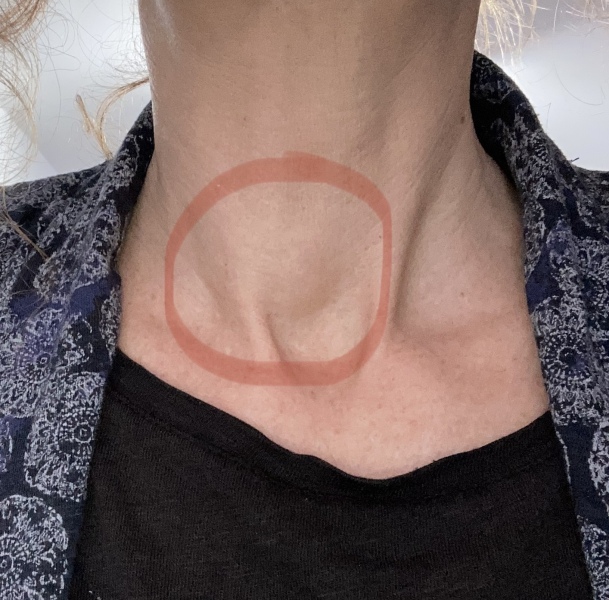 Thyroid swelling? What next?