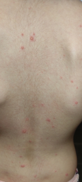 Blistery rash all over DD pics attached 