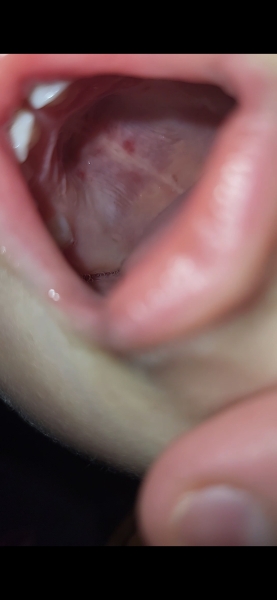 Red patches ans lumpy tongue?