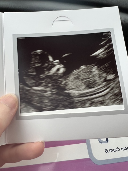 Short luteal phase?