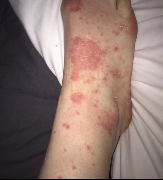 psoriasis?