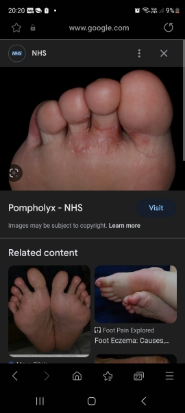 Athletes foot that won't go away