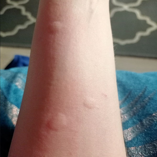 Itchy rash 