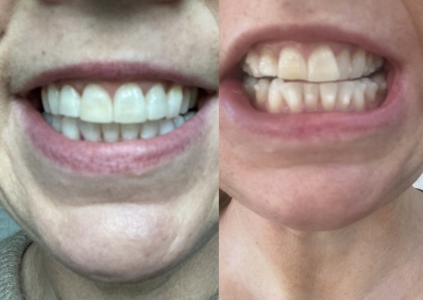 Invisalign has been the biggest waste of time and money!!