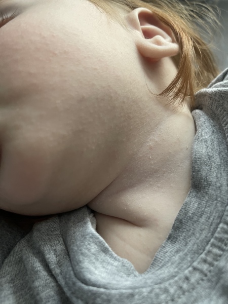 Rash/ Spots