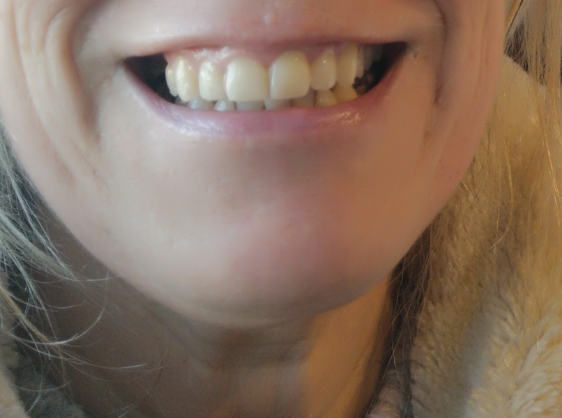 AIBU to stop invisalign on Day 2?