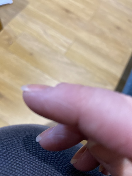 What's this growing on my finger? 