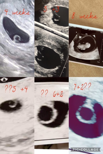 Baby Growth in early Pregnancy and been told to prepare for worst.