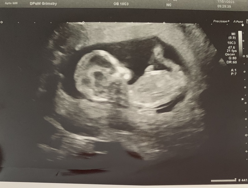 Has anyone been told the gender at 12 week scan?