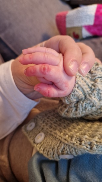 Blisters on 3 month old hand- please help!