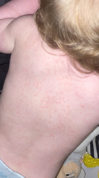 Chicken pox?