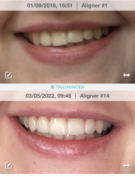 AIBU to stop invisalign on Day 2?