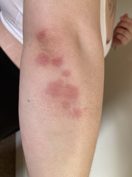 Does anyone know what these bites are?
