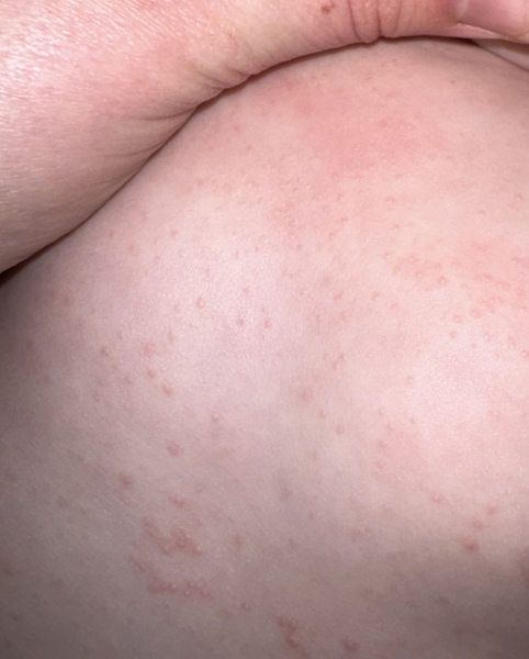 Itchy Rash - Advice welcome please! 