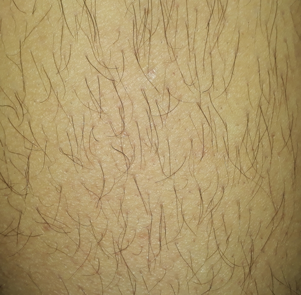 Will a lumea work (with hairy leg pics)?
