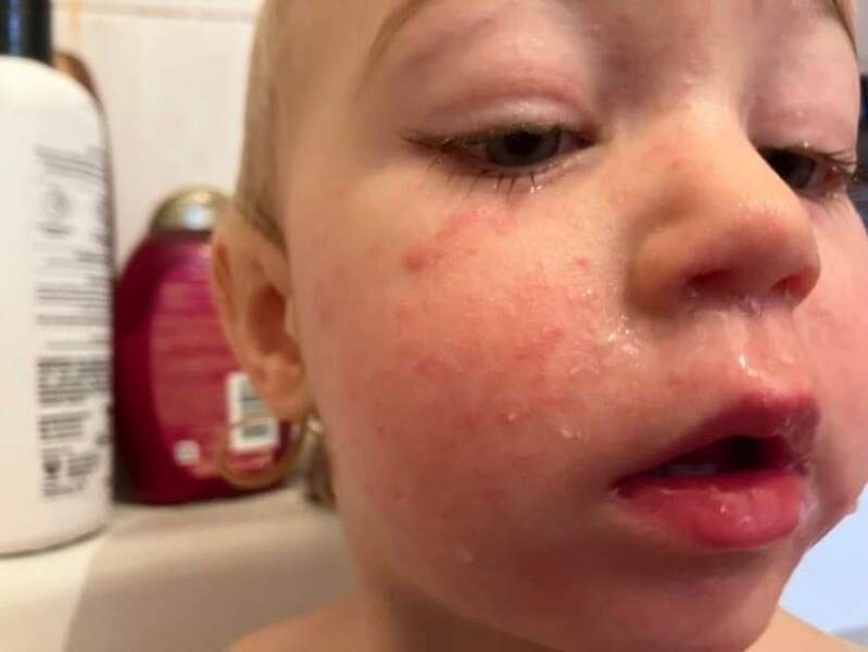 Rash - any ideas 