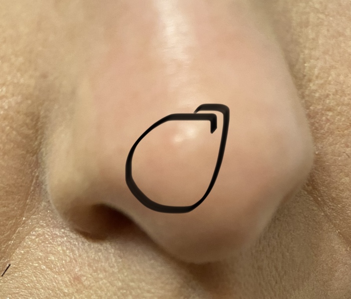 Skin/Spot worry 