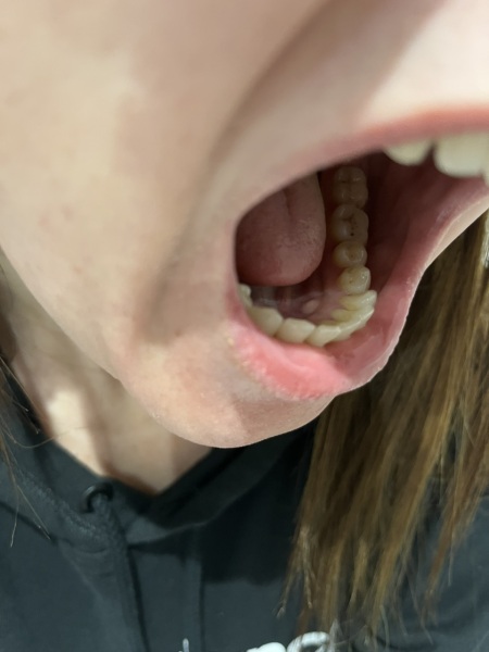 Gum lump - PHOTOS INC