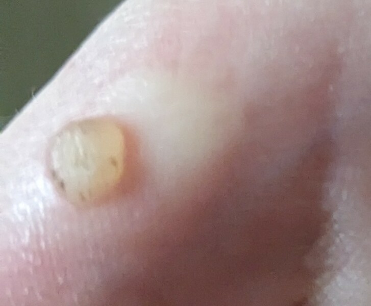 Wart progress 