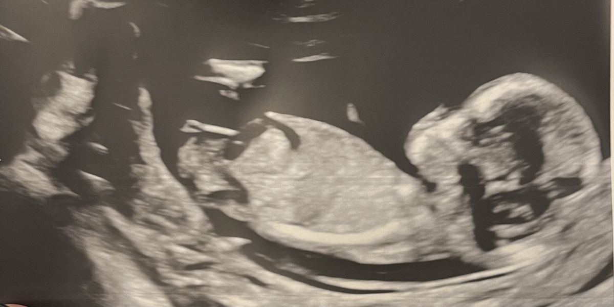 Nub theory - boy or girl? :-)