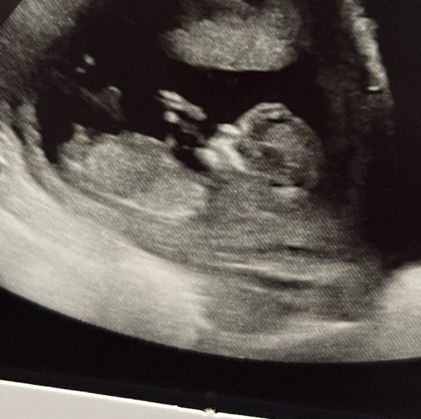 Nub/skull theory , 12 week scan thoughts ? 