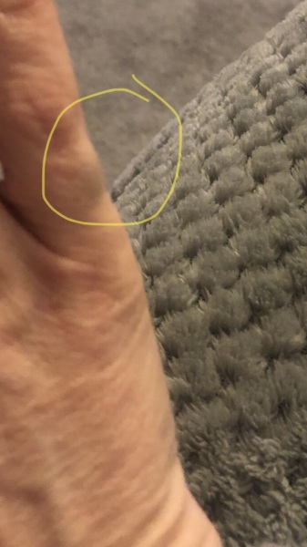 Lump on pinky finger