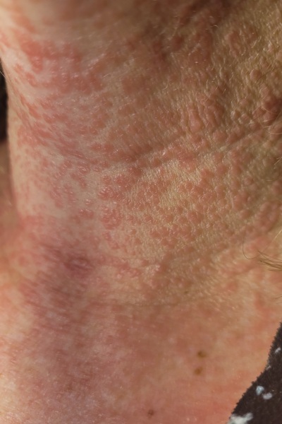 Please help me identify this rash