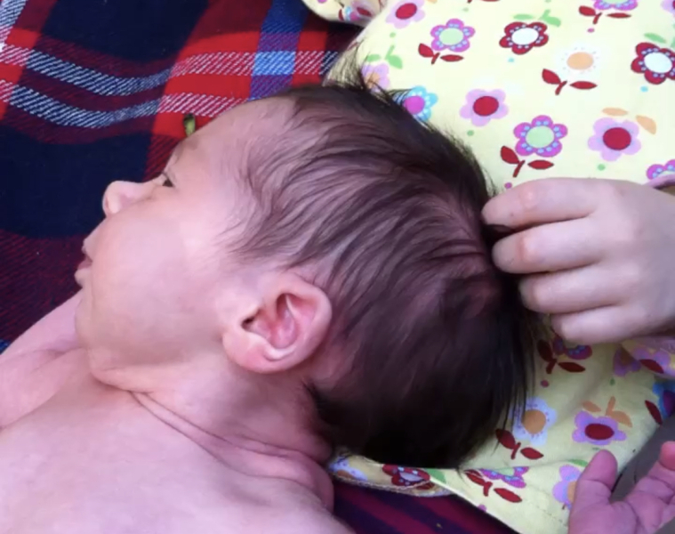 Worried sick. Is this craniosynostosis ?!
