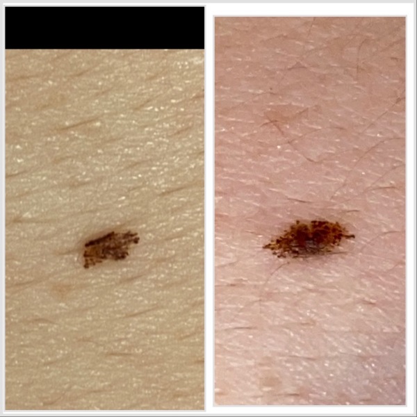 Melanoma what next?